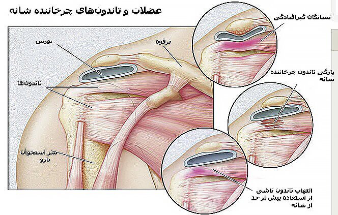 تقویت عضلات شانه در منزل با چند حرکت ساده تقویت عضلات شانه در منزل با چند حرکت ساده