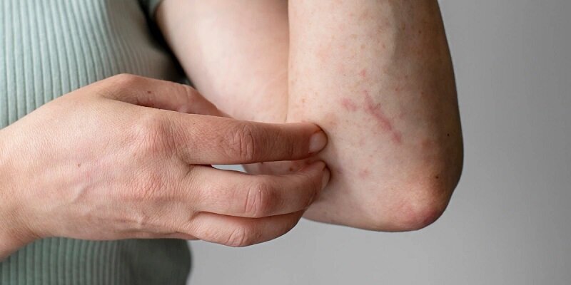 دیابت اینگونه خودش را روی پوست شما نشان می‌دهد!