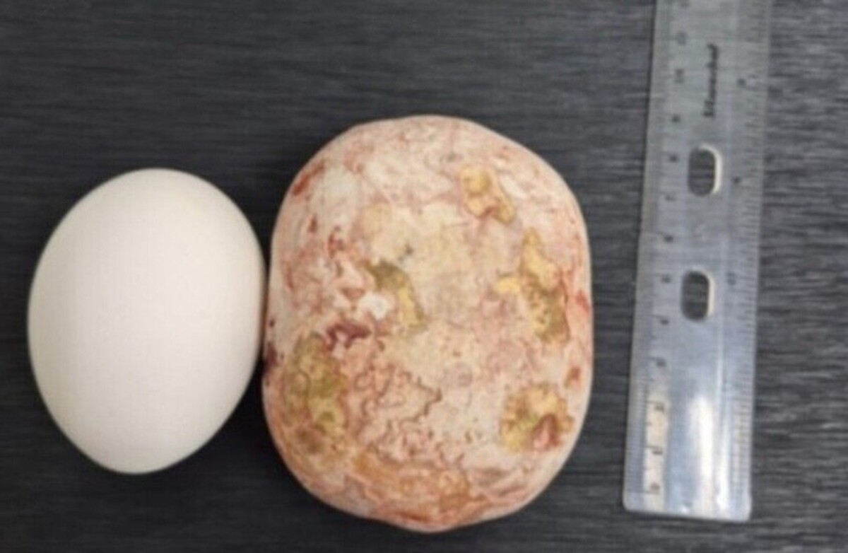 پزشکان روسی سنگ غول‌پیکر یک کیلوگرمی را از مثانه یک مرد خارج کردند