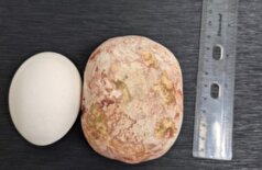 پزشکان روسی سنگ غول‌پیکر یک کیلوگرمی را از مثانه یک مرد خارج کردند