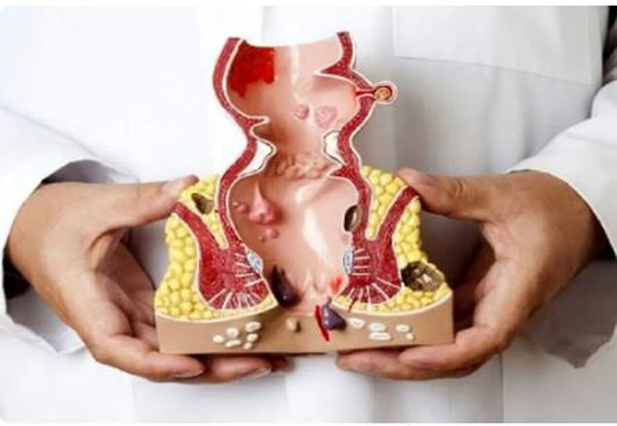 چرا بواسیر بوجود می‌آید و چگونه آن را درمان کنیم؟