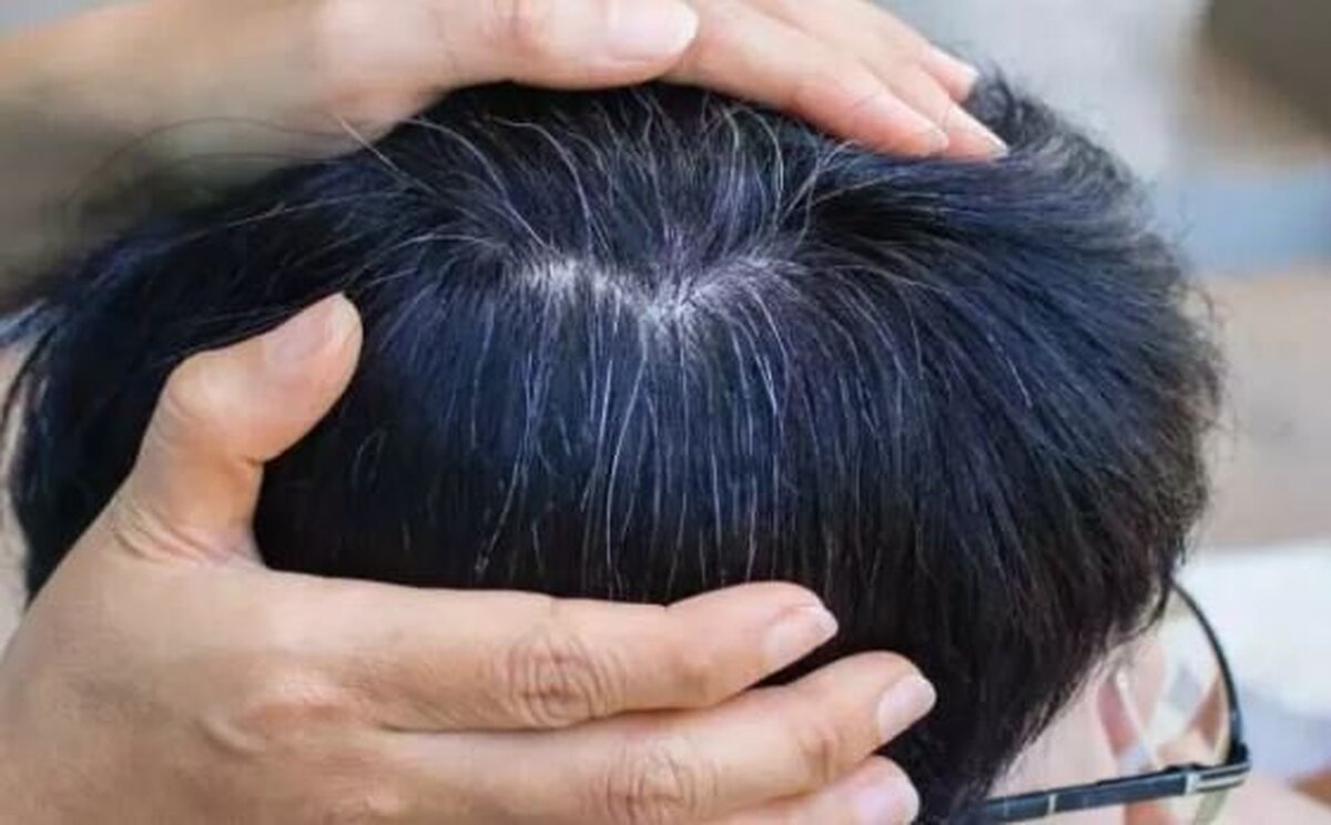 ارتباط بین سفیدی مو و یکی از خطرناک‌ترین سرطان‌های پوستی!