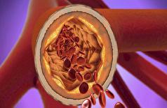 یک داروی جدید کلسترول بد را به میزان بی‌سابقه‌ای کاهش می‌دهد