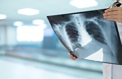 آزمایش بالینی، داروی جدیدی را برای مبارزه با سل مقاوم به دارو معرفی کرد