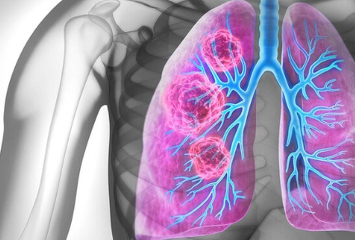 افراد غیرسیگاری هم سرطان ریه میگیرند؟