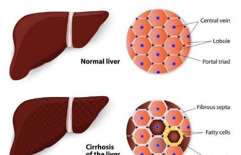 علائم سیروز کبدی و بیماری قلب دوم را جدی بگیرید