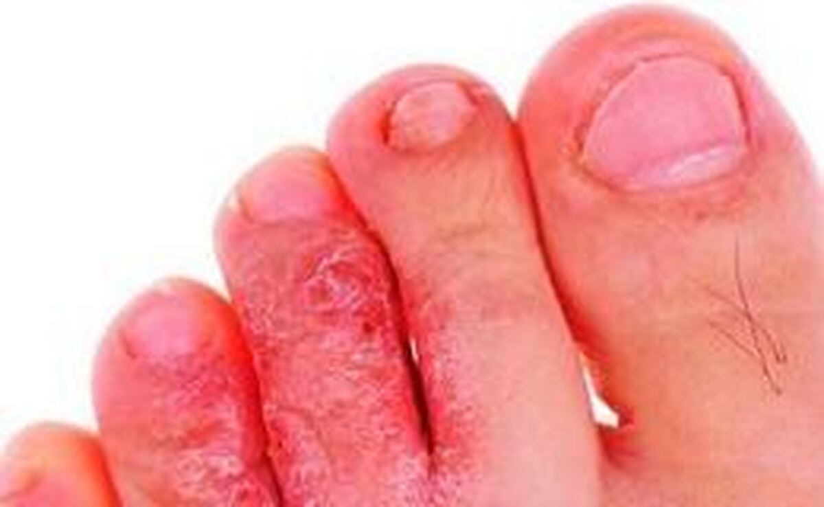 چند تکنیک و راهکار خانگی برای درمان فوری عفونت پای ورزشکاران