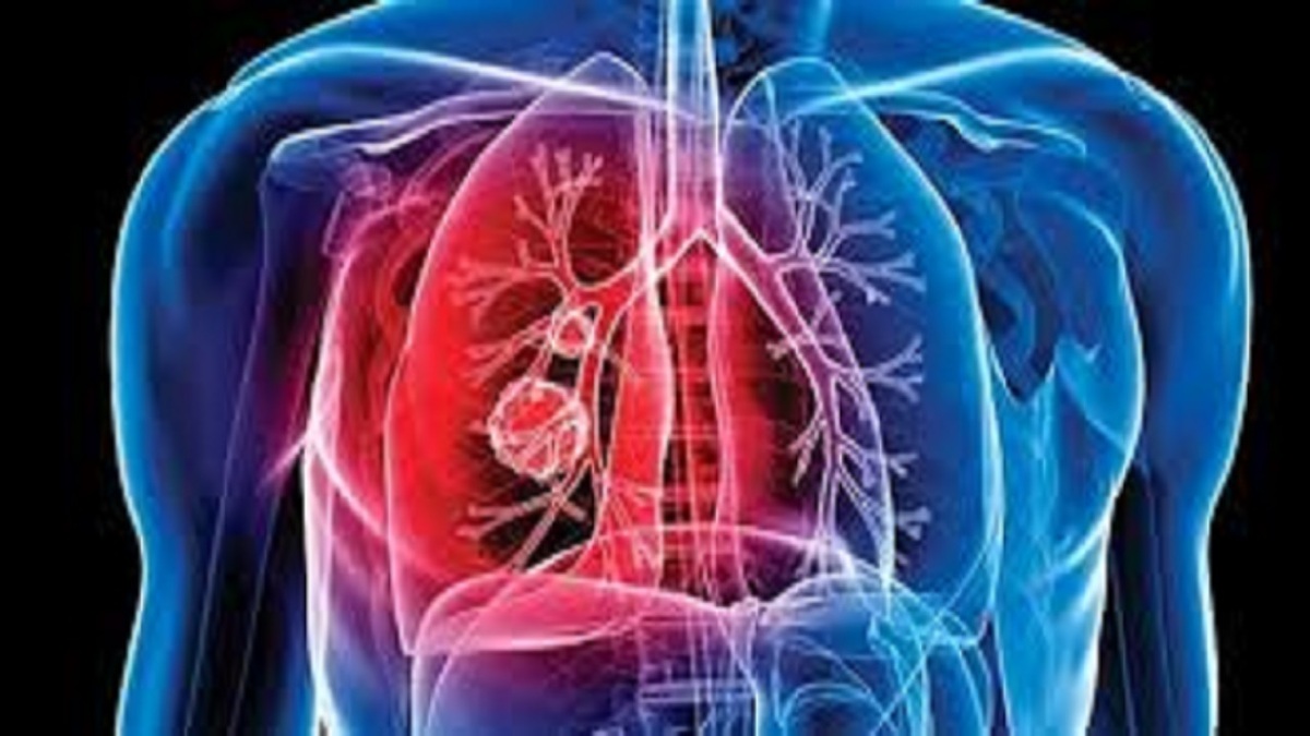 شناسایی ۲۵ بیمار جدید مبتلا به سل در سنندج