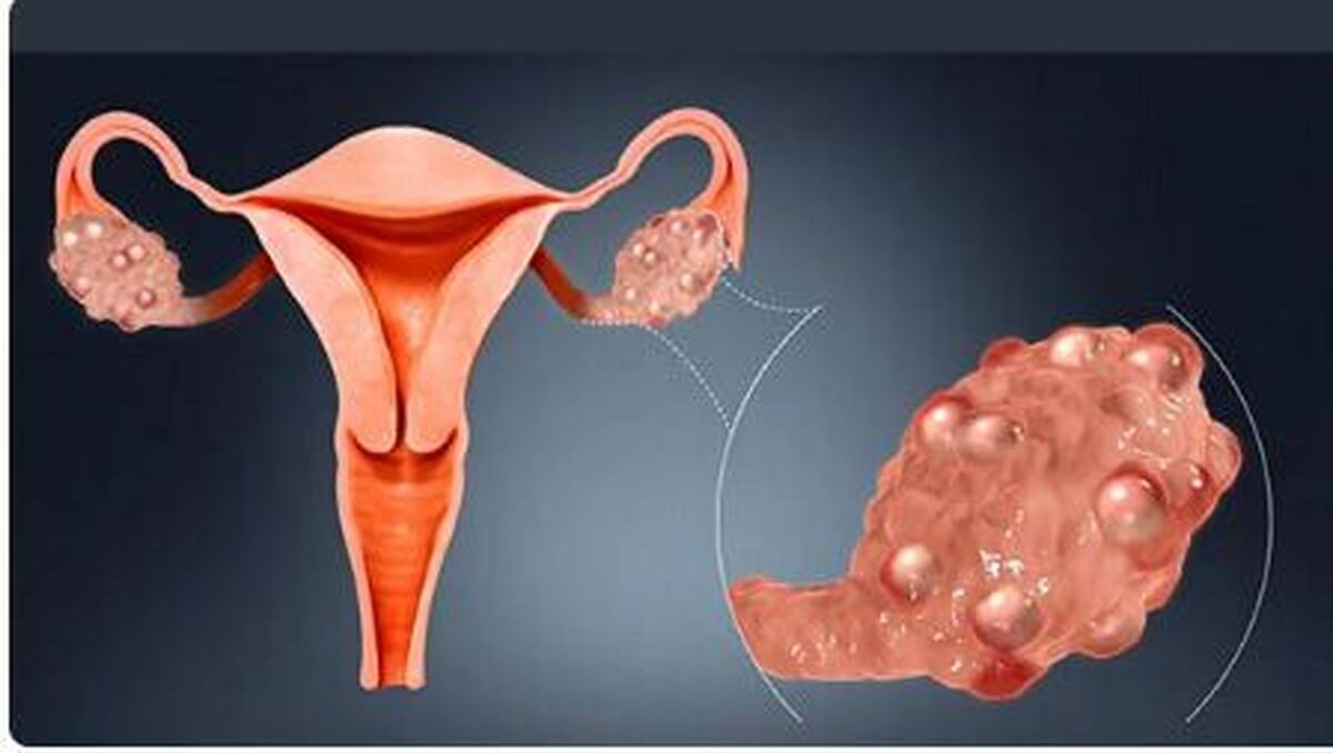 آیا کیست تخمدان با 
