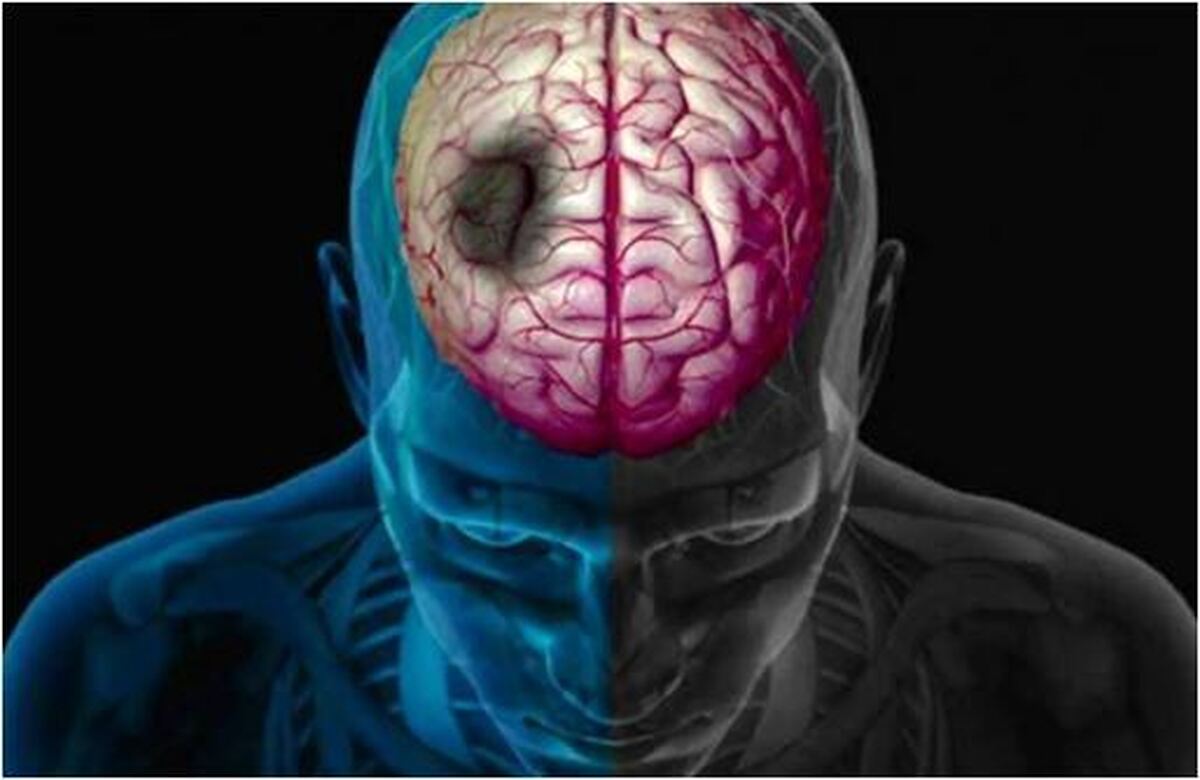 آمار بالا و نگران کننده سکته مغزی در تهران