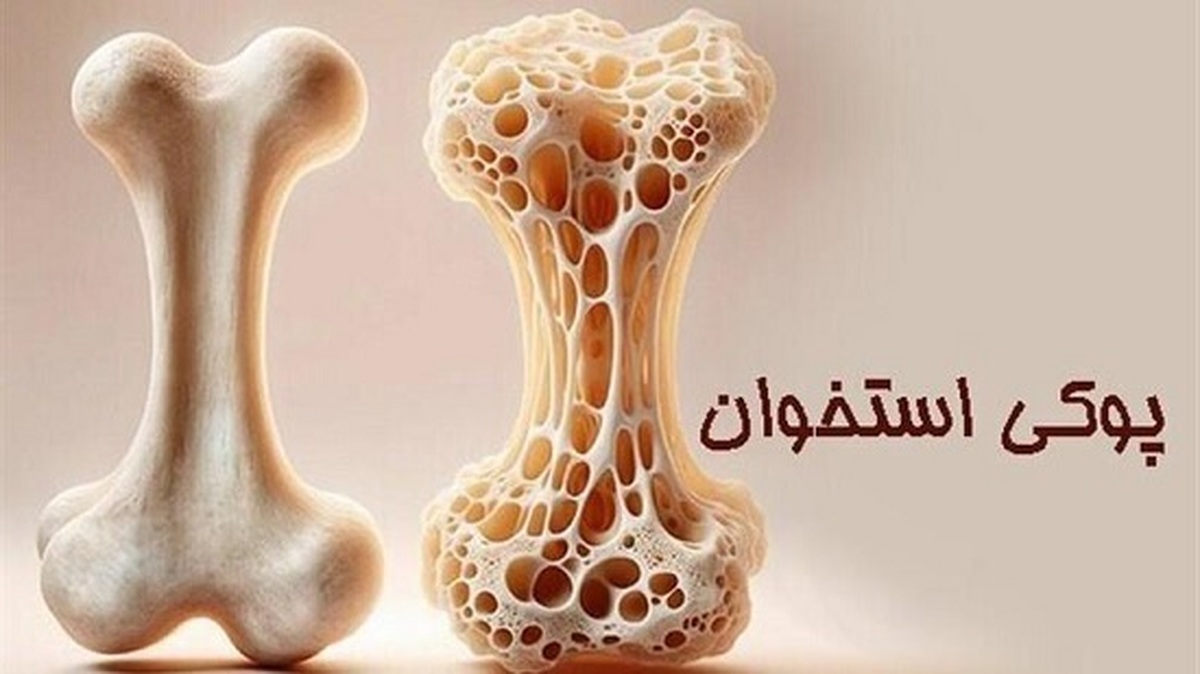 چگونه پوکی استخوان را شناسایی کنیم؟