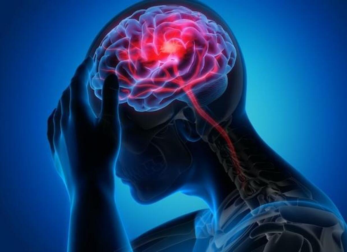 آمار عجیب ابتلای افراد به سکته مغزی!