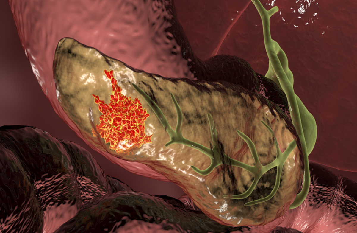 «مهمترین گام در ۵۰ سال گذشته»: آزمایش تنفسی انقلابی، سرطان پانکراس را در مراحل اولیه تشخیص میدهد