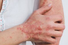 دیلی میل: پسوریازیس ممکن است خطر حمله قلبی و سکته مغزی را افزایش دهد