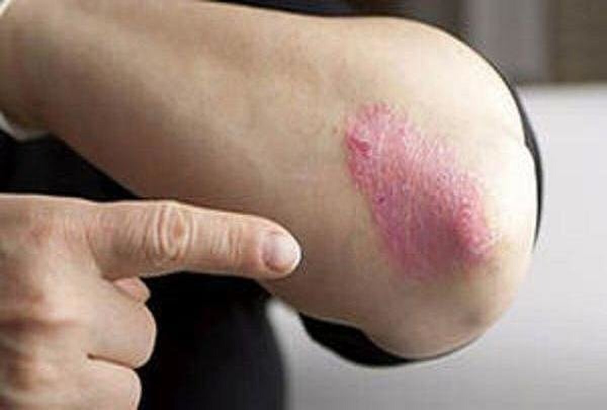 بیماری پسوریازیس باید سریعا تشخیص داده شود!