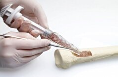 روسیه یک ماده زیست تخریب پذیر برای بهبود بازسازی استخوان تولید می‌کند