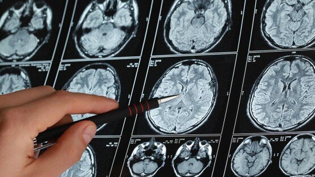 تنها فرصت درمان سکته مغزی را بدانید