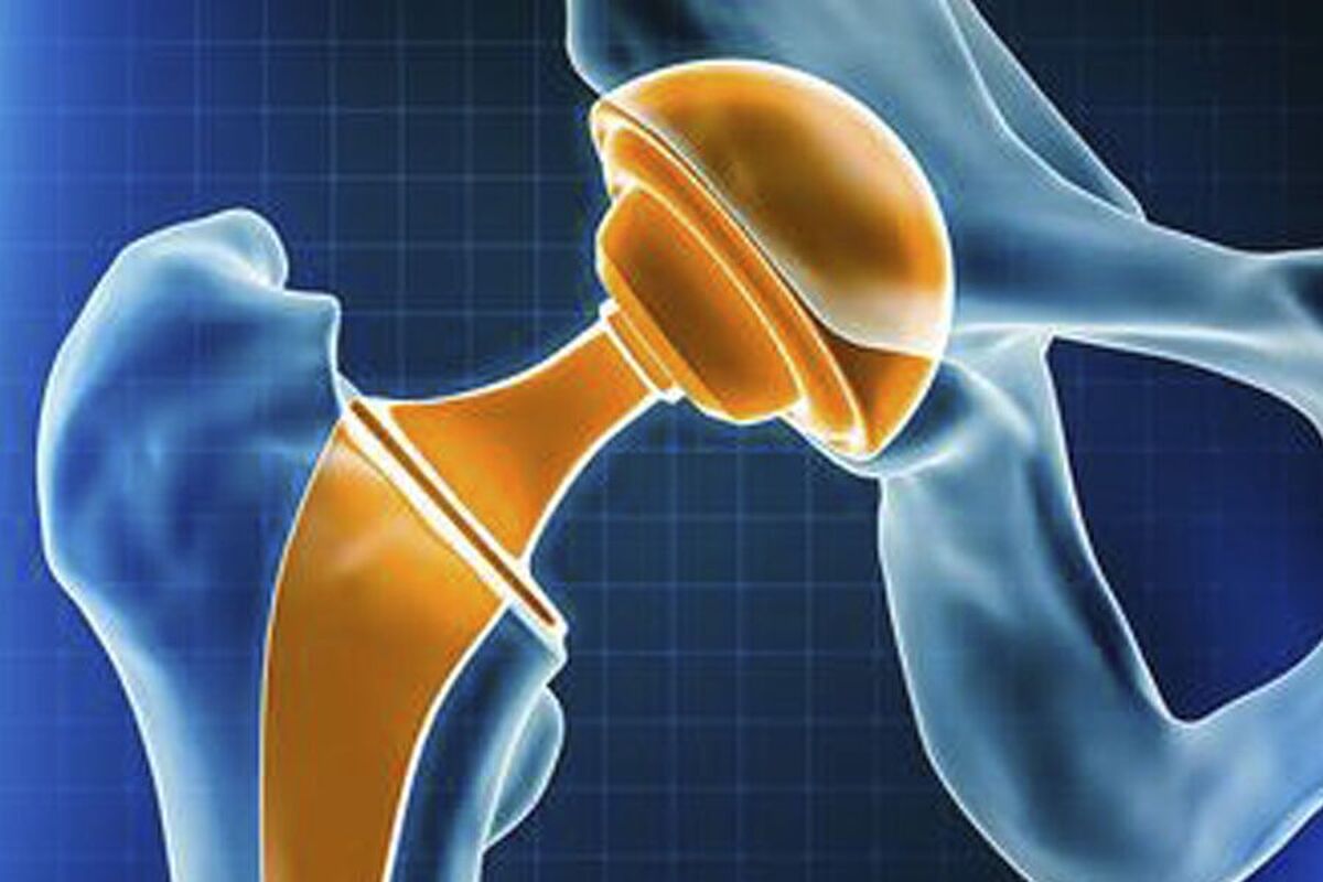 دانشمندان روسی فایده غیرمنتظرهای در پروتزهای استخوانی آسیبدیده یافتهاند