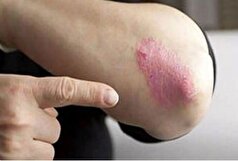 آشنایی کامل با علائم و نشانه‌های بیماری «پسوریازیس»