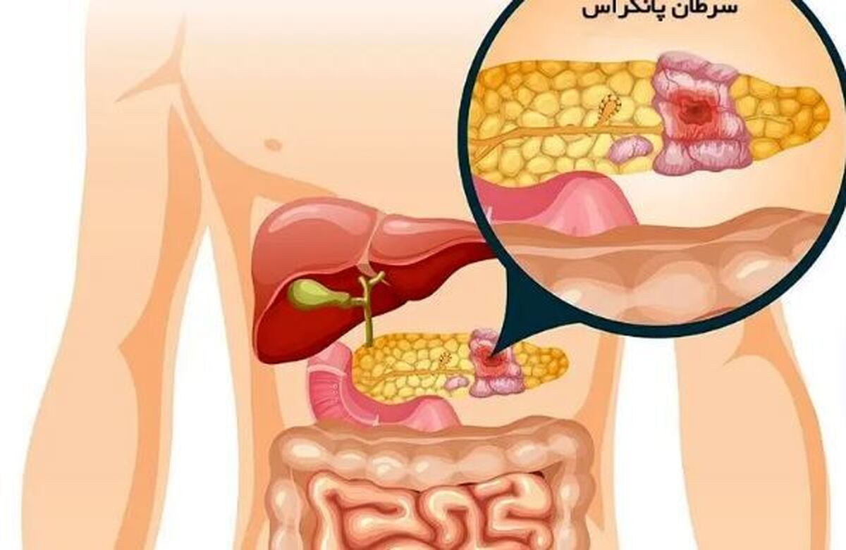 نشانه اولیه سرطان مرگبار پانکراس در پا‌های شما نمایان می‌شود
