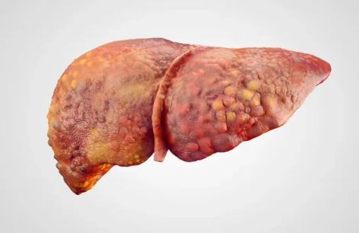 سیروز کبدی؛ بیماری که نشان دهنده فرسایش بزرگ‌ترین غده بدن انسان است