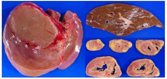 سیروز کبدی؛ بیماری که نشان دهنده فرسایش بزرگ‌ترین غده بدن انسان است