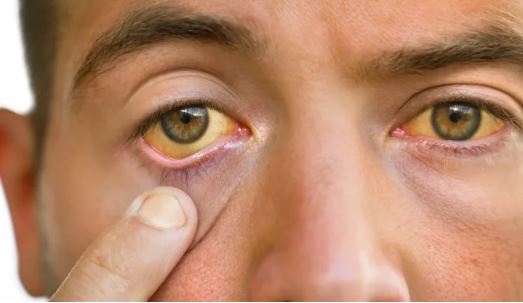 سیروز کبدی؛ بیماری که نشان دهنده فرسایش بزرگ‌ترین غده بدن انسان است