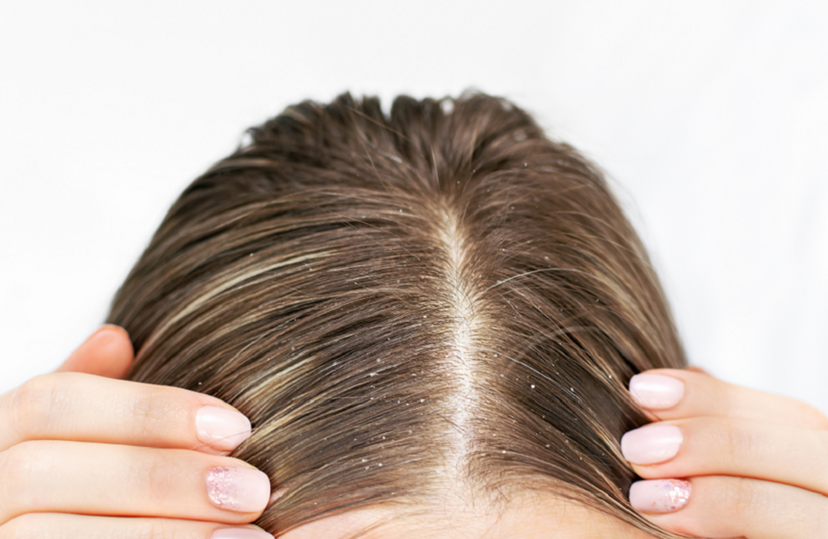 علت پنهان شوره سر آزاردهنده