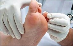 کشف روش جدید برای درمان زخم‌های مزمن