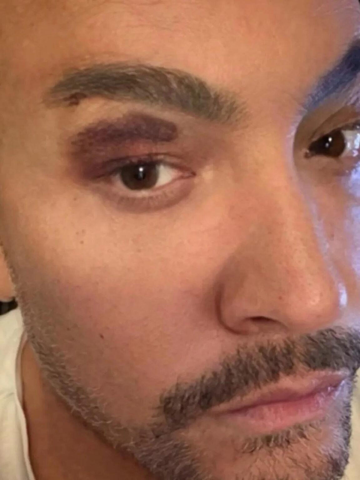 ماجرای عجیب شکستگی ابروی «جنگ ارن» مشخص شد