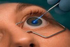 درمان‌های لیزری پیر چشمی برای چه سنی توصیه میشود؟