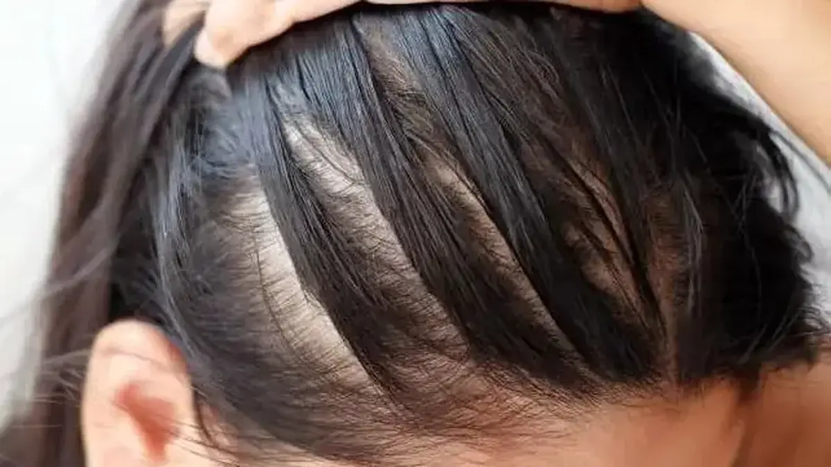 حتی یک استرس کوچک هم سال‌ها بعد به عامل ریزش مو تبدیل میشود!