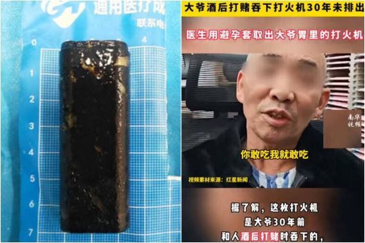 فندکی که ۳۰ سال پیش توسط مرد چینی بلعیده شده بود به تازگی برایش درد شکمی ایجاد کرد!