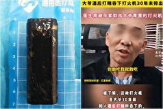 فندکی که ۳۰ سال پیش توسط مرد چینی بلعیده شده بود به تازگی برایش درد شکمی ایجاد کرد!