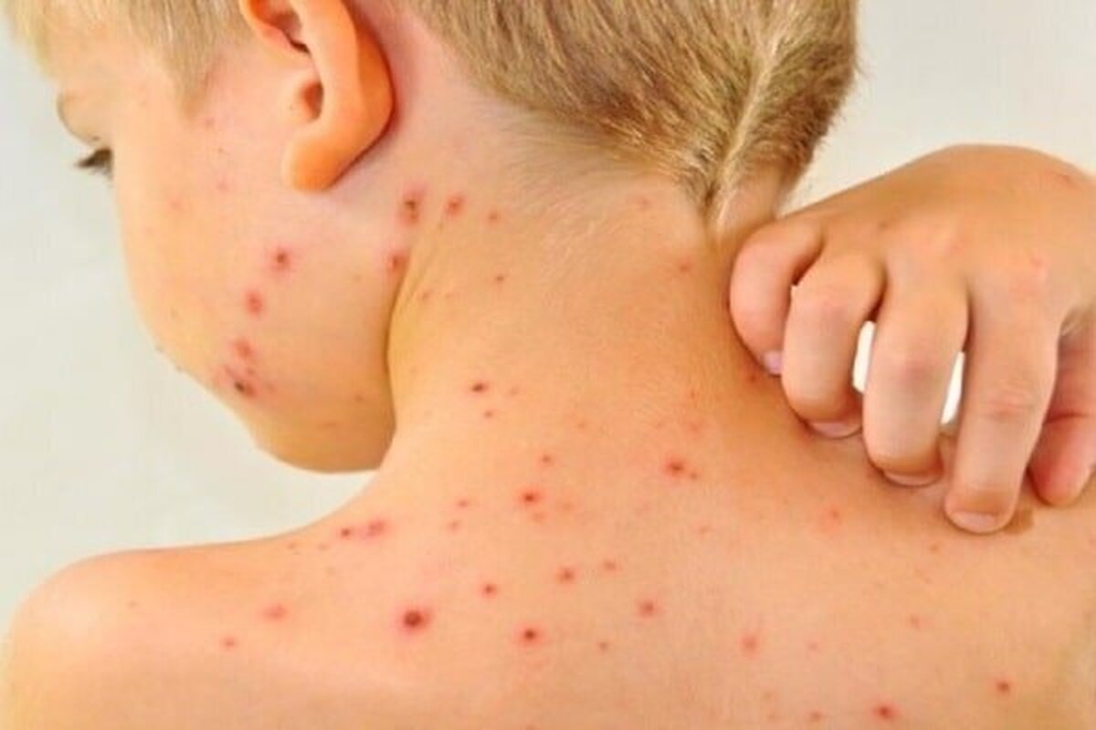 مرگ و میر ناشی از سرخک در جهان چگونه تغییر خواهد کرد؟