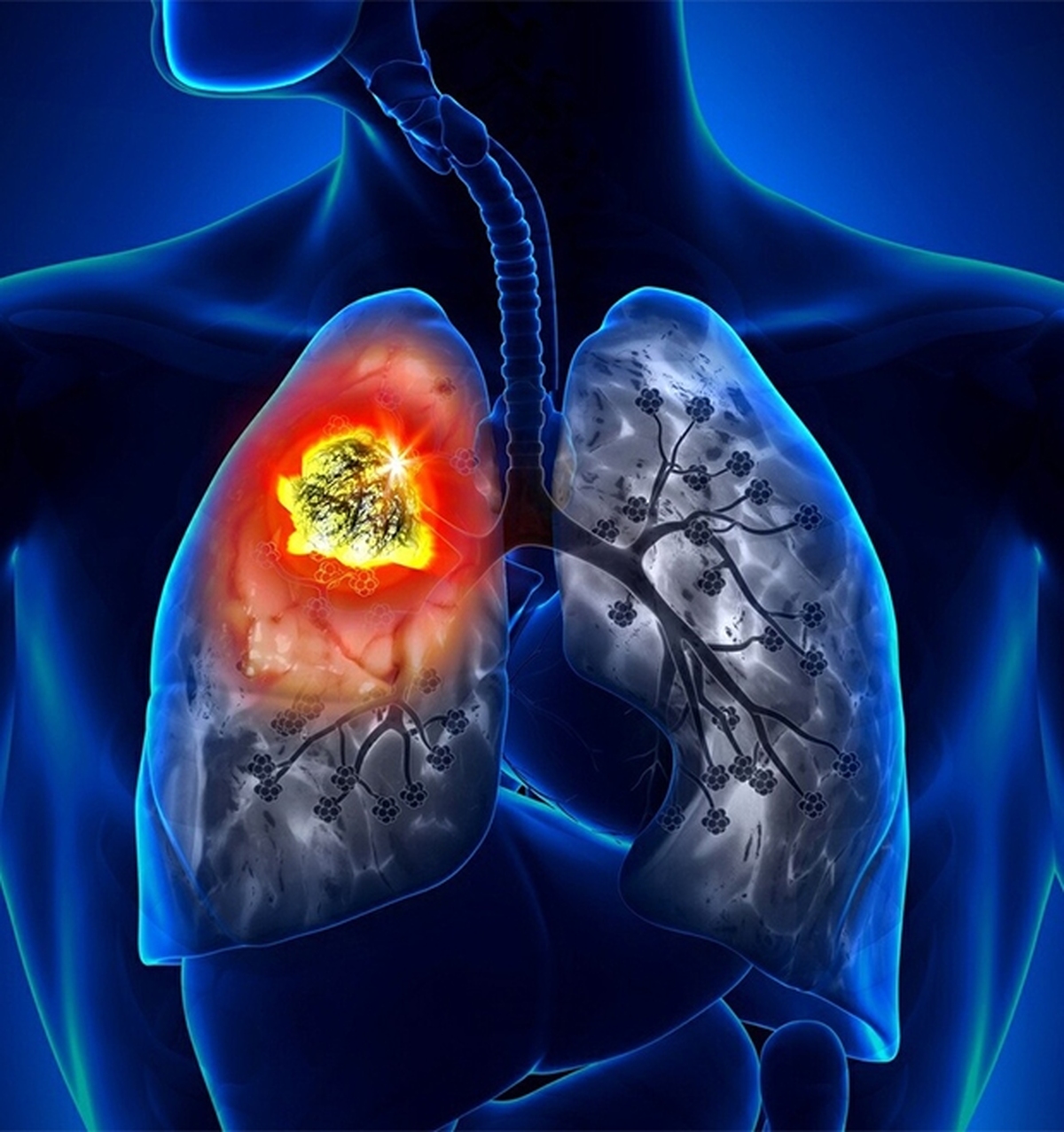 چگونه می‌توان با نگاه کردن به دست، سرطان ریه را تشخیص داد؟