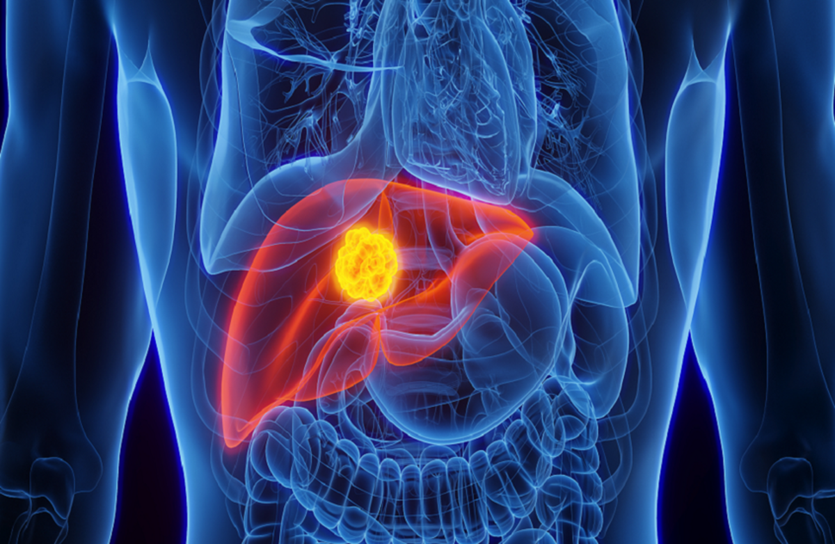 روشی ساده برای شناسایی بیماران در معرض خطر سرطان کبد