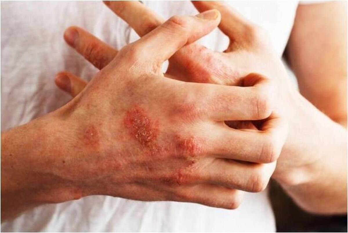 بیماری خود ایمنی با چه نشانه‌هایی ظاهر می‌شود؟