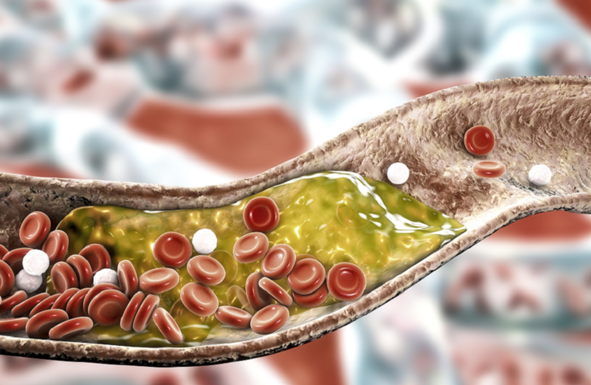 یک دوز از داروی جدید می‌تواند کلسترول را برای تمام عمر کاهش دهد