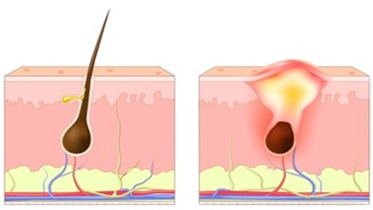 آکنه معکوس چیست؟ با چه علائمی ظاهر میشود؟