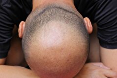 درمان‌های موضعی برای طاسی: یک پزشک توضیح داد که چگونه می‌توان از مو محافظت کرد.