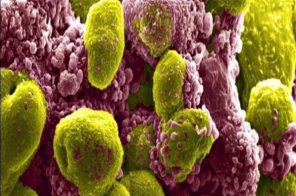 سرطان حاد پروستات قابل درمان است!