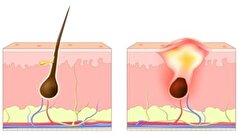 آکنه معکوس چیست؟ با چه علائمی ظاهر میشود؟