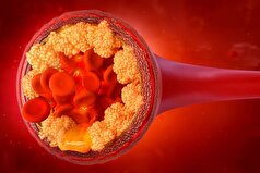 یک بیماری شایع که سطح کلسترول خون را به میزان قابل توجهی افزایش می‌دهد، شناسایی شده است.