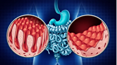 بیماری سلیاک چیست و چرا بعضی افراد به آن مبتلا می‌شوند؟ /علائم+ روش درمان