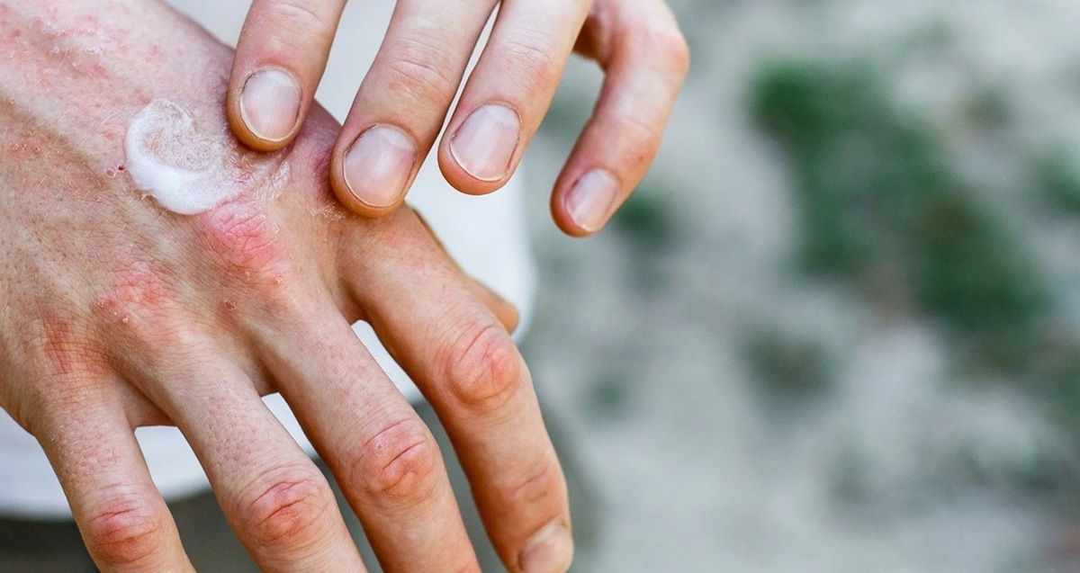 خشکی پوست فصل زمستان را چگونه برطرف کنیم؟