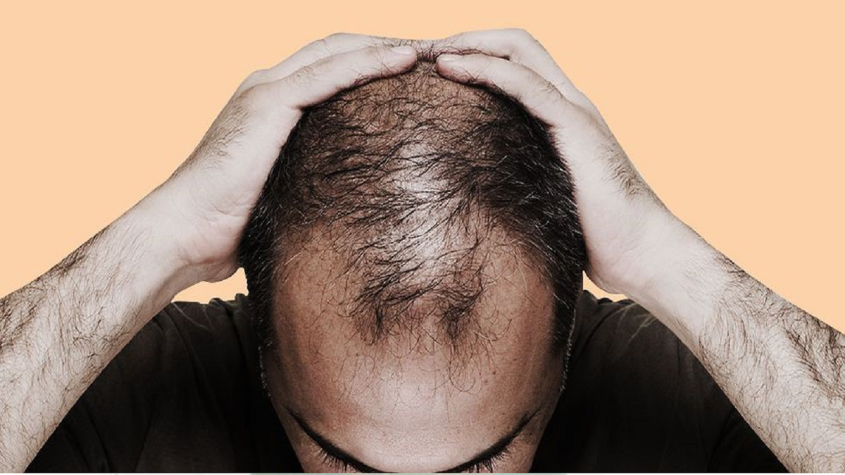 استرس میتواند علت ریزش مو باشد؟