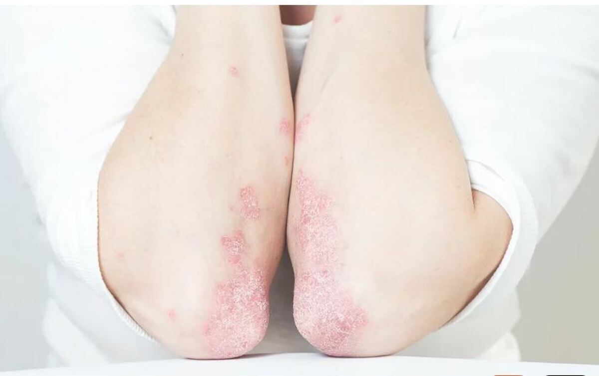 آیا می‌دانستید خواب کافی شما را از پسوریازیس دور می‌کند؟