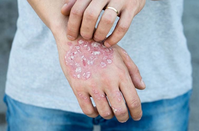 آیا میدانستید خواب کافی شما را از پسوریازیس دور میکند؟ آیا میدانستید خواب کافی شما را از پسوریازیس دور میکند؟