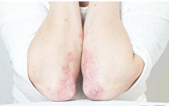 آیا می‌دانستید خواب کافی شما را از پسوریازیس دور می‌کند؟